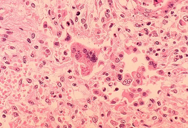 Histopathology of measles pneumonia. Giant cell with intracytoplasmic inclusions. Source: Centers for Disease Control